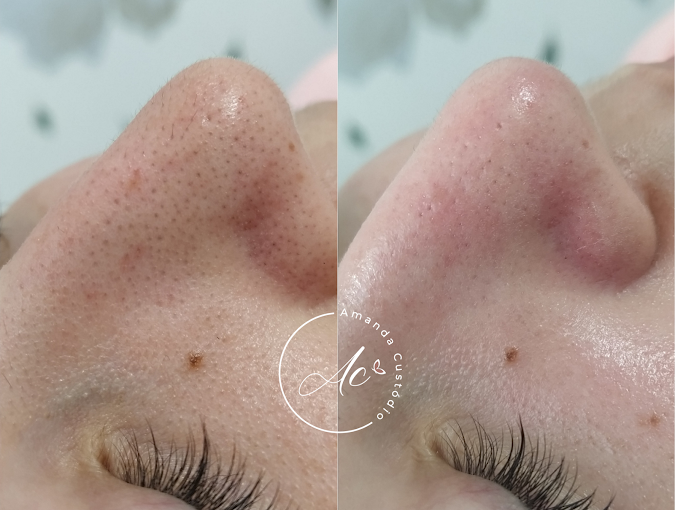 Foto de antes e depois de uma limpeza de pele, close no nariz